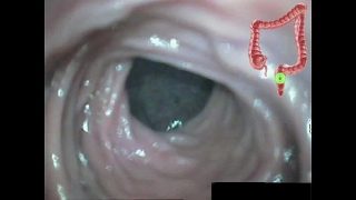Anal Colon Condition